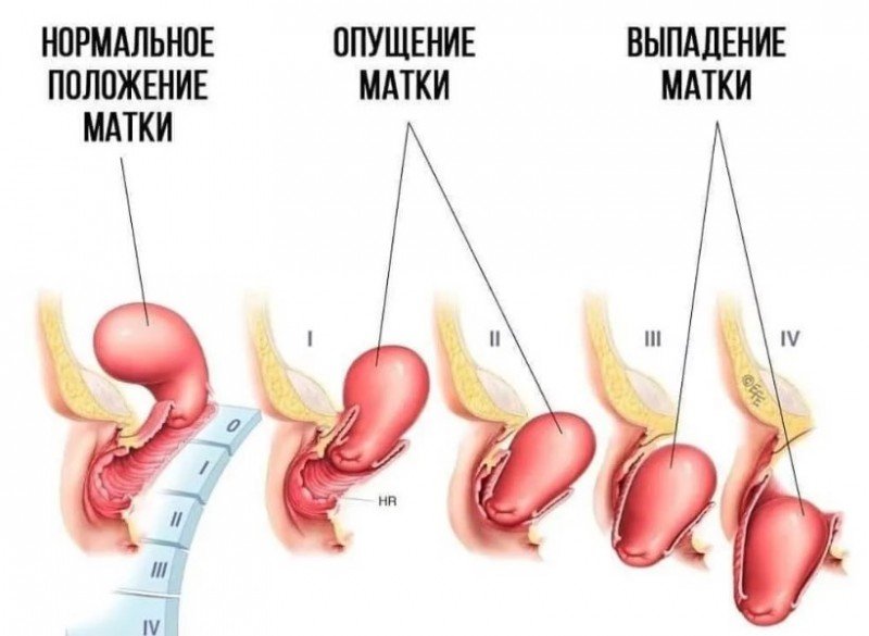 Все о пролапсе матки